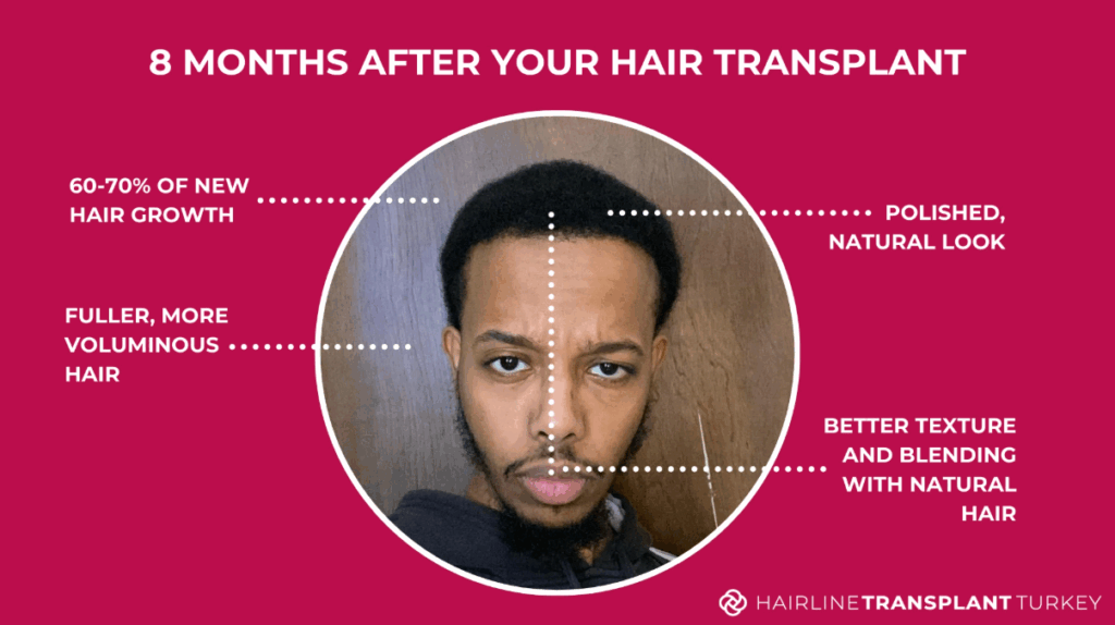 8 months after hair transplant - here is what to expect at the 8 month mark after your hair transplant