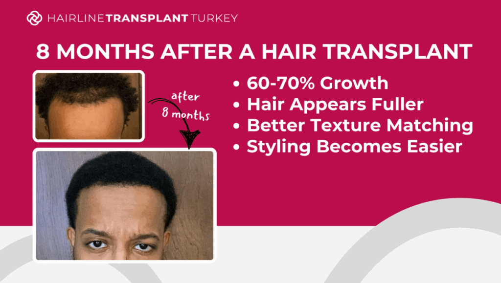 8 months after hair transplant - here is what to expect at the 8 month mark after your hair transplant