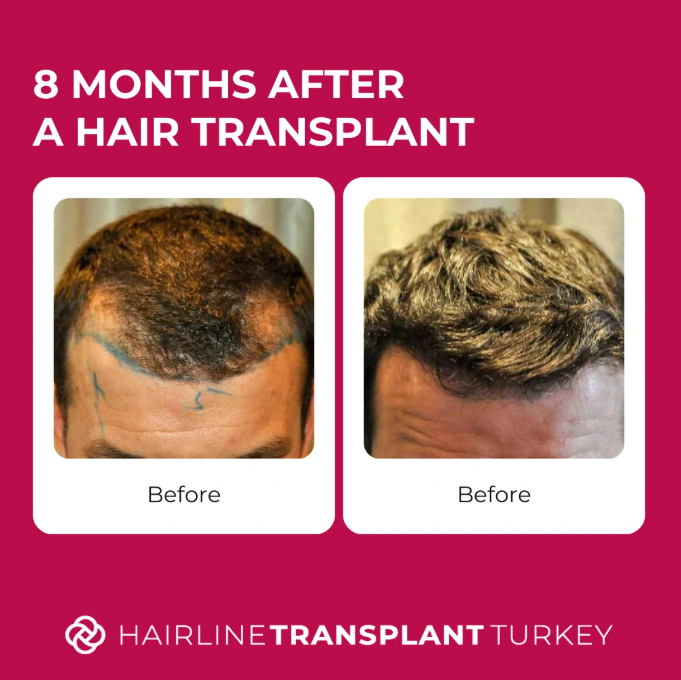 8 months after hair transplant - here is what to expect at the 8 month mark after your hair transplant impressive before and after pictures