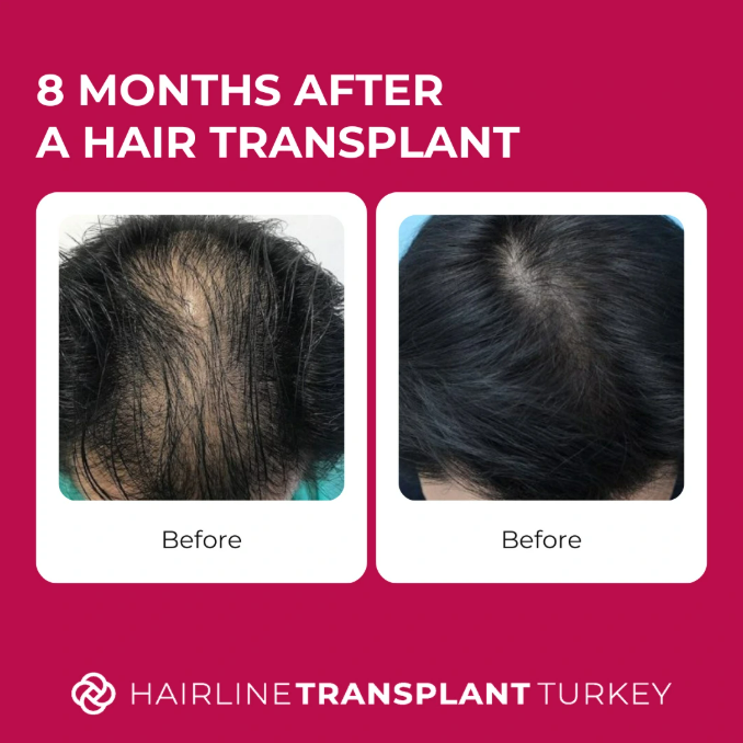 8 months after hair transplant - here is what to expect at the 8 month mark after your hair transplant impressive before and after pictures
