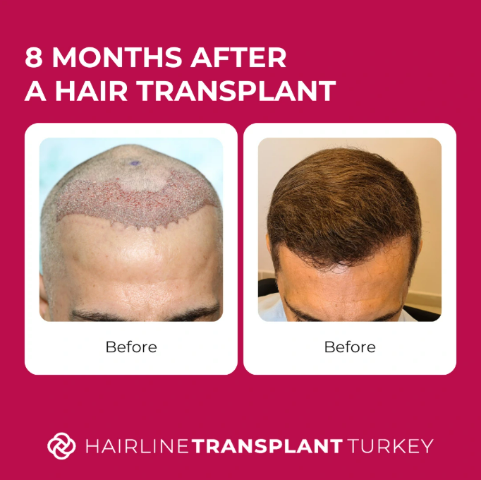 8 months after hair transplant - here is what to expect at the 8 month mark after your hair transplant impressive before and after pictures