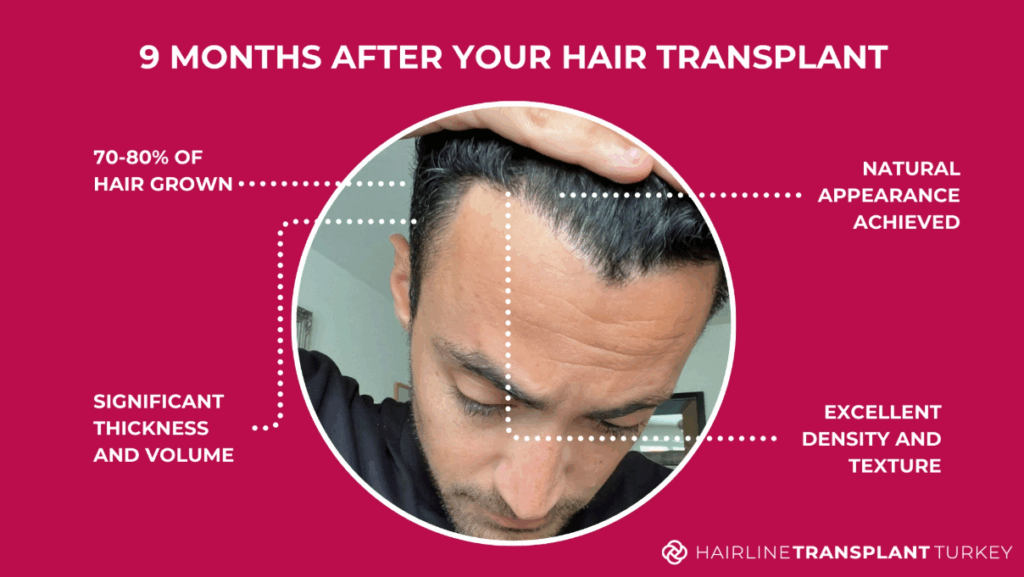 9 months after hair transplant - here is what to expect at the 9 month mark after your hair transplant
