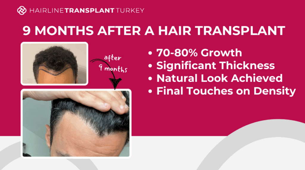 9 months after hair transplant - here is what to expect one year after your hair transplant