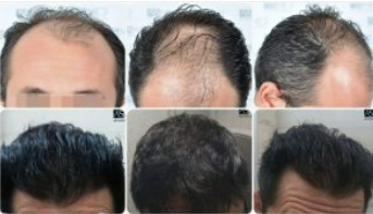 ASMED Before After Pictures