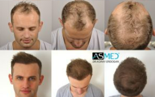 ASMED Before After Pictures