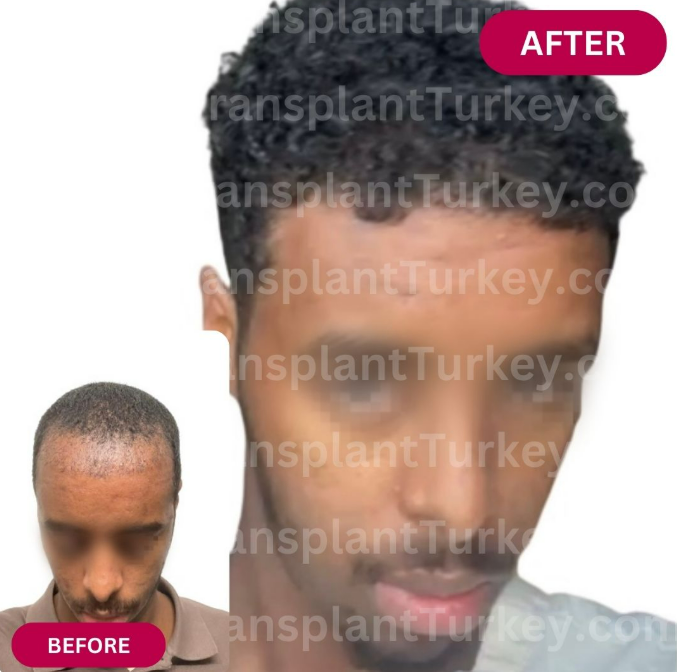 Afro Hair Transplant Before and after