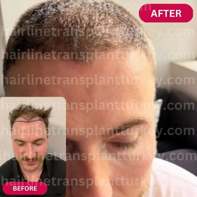 After pictures from FUE hair transplant