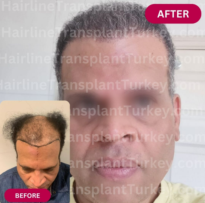 Before and after afro hair transplant