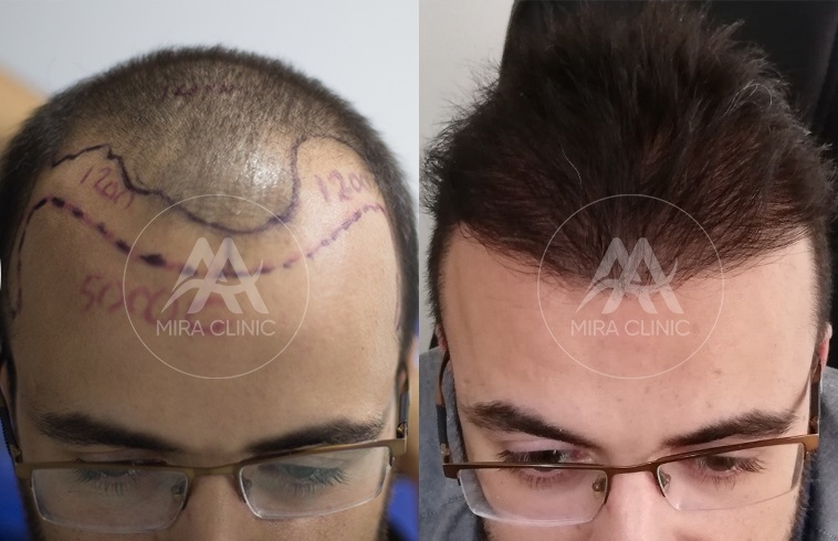 Mira Clinic reviews before and after picture