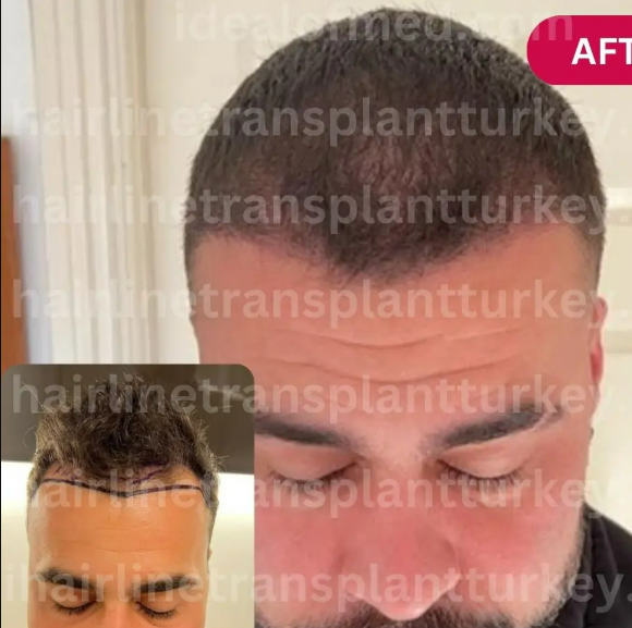 Before and After FUE hair transplant