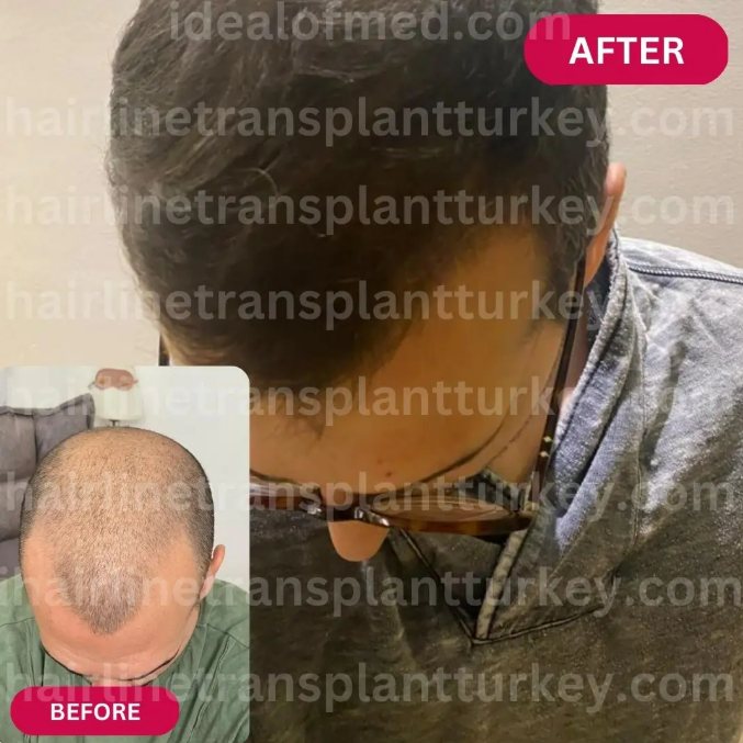 FUE Hair Transplant procedure results
