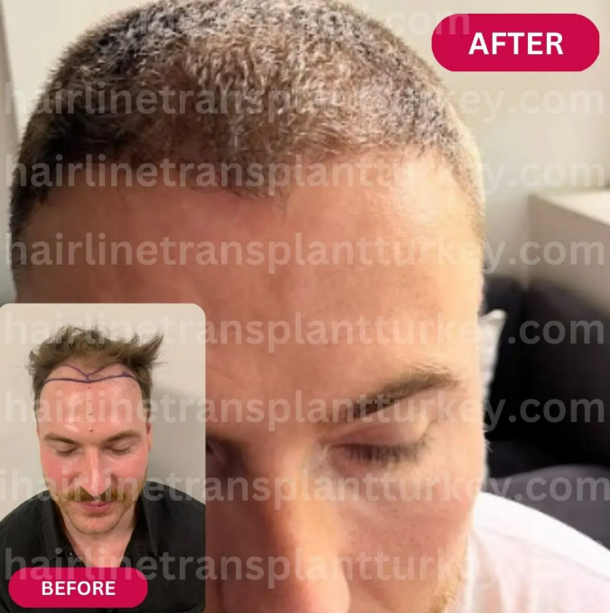 After pictures from FUE hair transplant