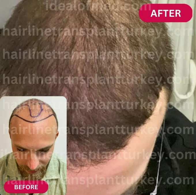 Picture of FUE hair transplant