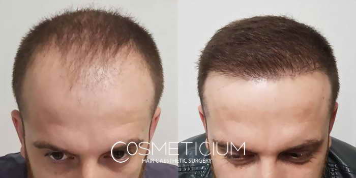 Cosmeticium Turkey Reviews: Before and After Pictures