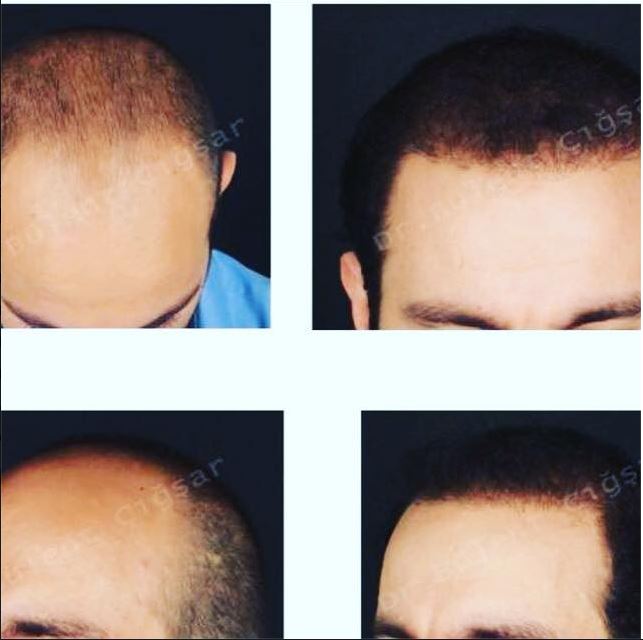 Expert Hair Transplant Turkey: Before and After Picture