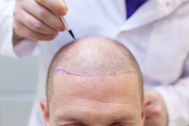 Hair Transplants during covid 19