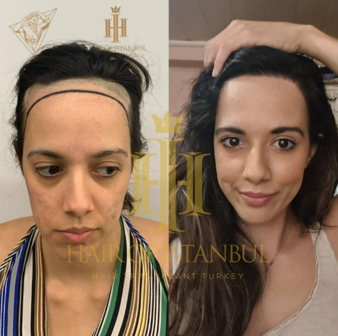 Hair of Istanbul Before & After photos