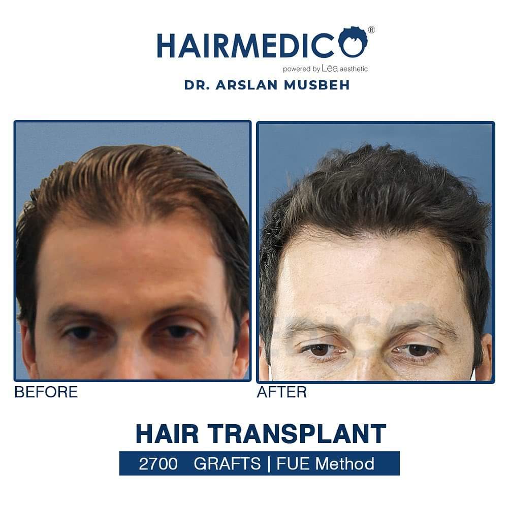 Hairmedico Clinic Review 1