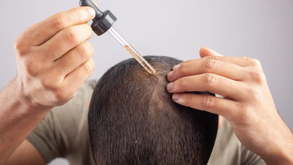How to Prepare for a Hair Transplant in Finland How to Prepare for a Hair Transplant in Finland