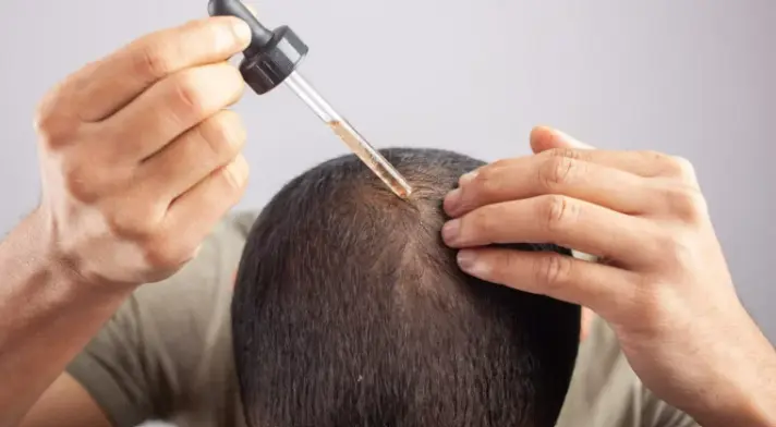How to Prepare for a Hair Transplant in Finland How to Prepare for a Hair Transplant in Finland