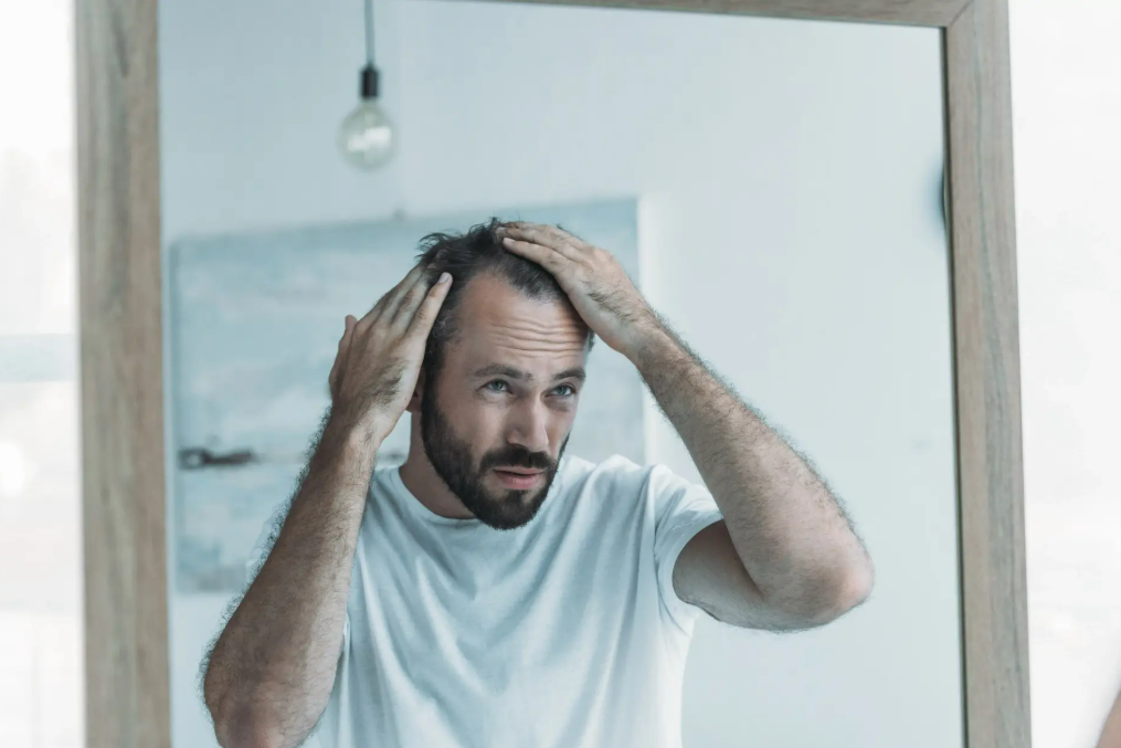 Man with hair loss considering FUE hair transplant Man with hair loss considering FUE hair transplant