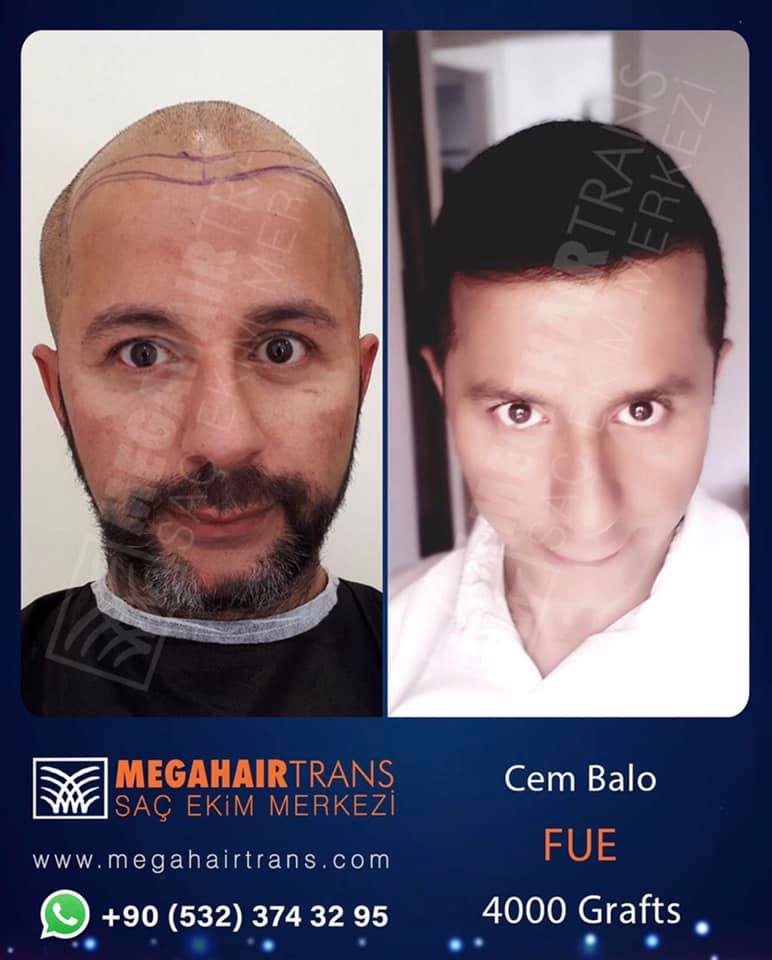 Mega Hair Transplant Centre review: Before and After Pictures