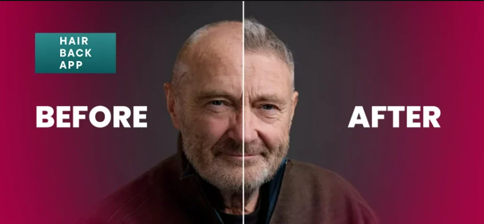 Phil Collins Hair Transplant