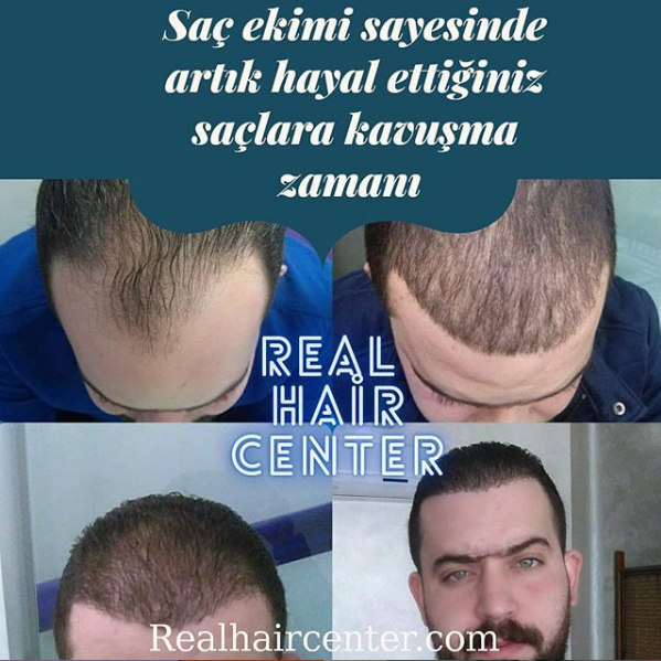 Real Hair Center Istanbul: Before and After Pictures