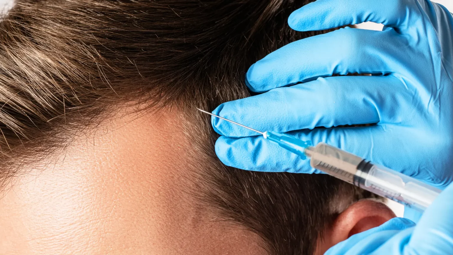 Therapy for hair loss