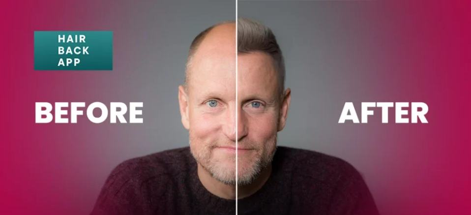 Woody Harrelson hair transplant