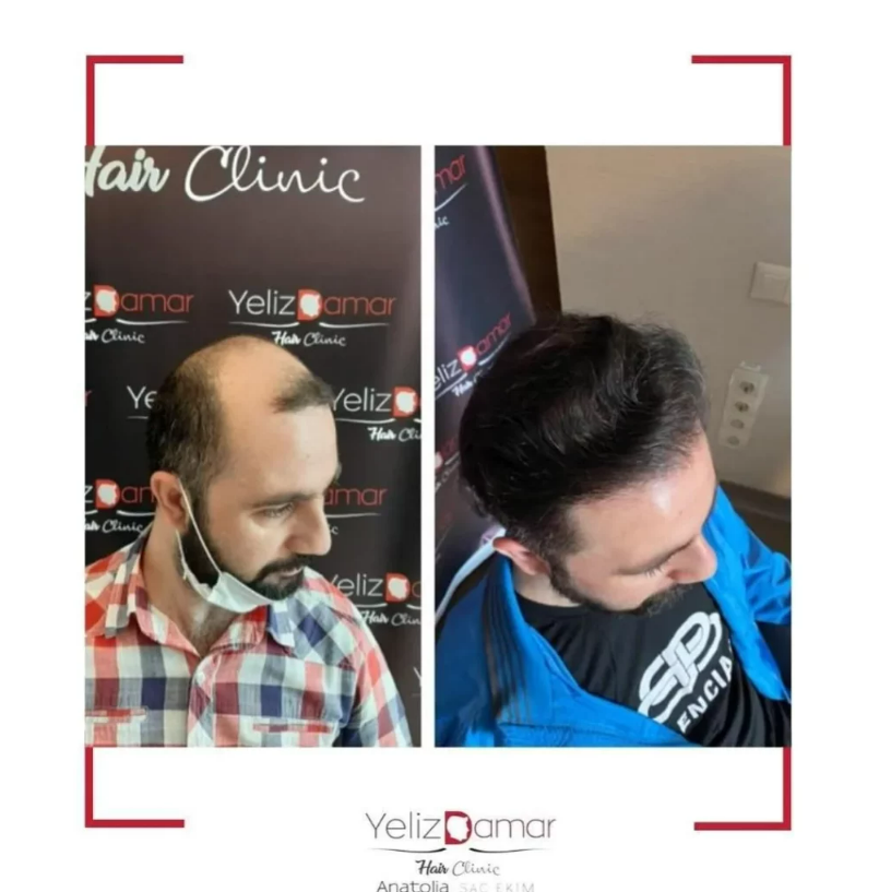 anatolian hair clinic before-after pictures