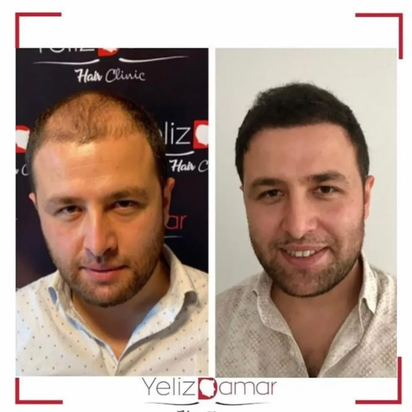 anatolian hair clinic before-after pictures