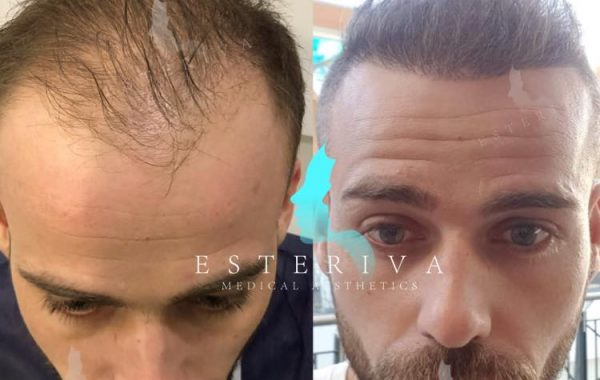 hairline-transplant-turkey-10 hairline-transplant-turkey-10