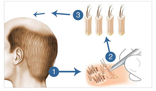 fue-hair-transplantation