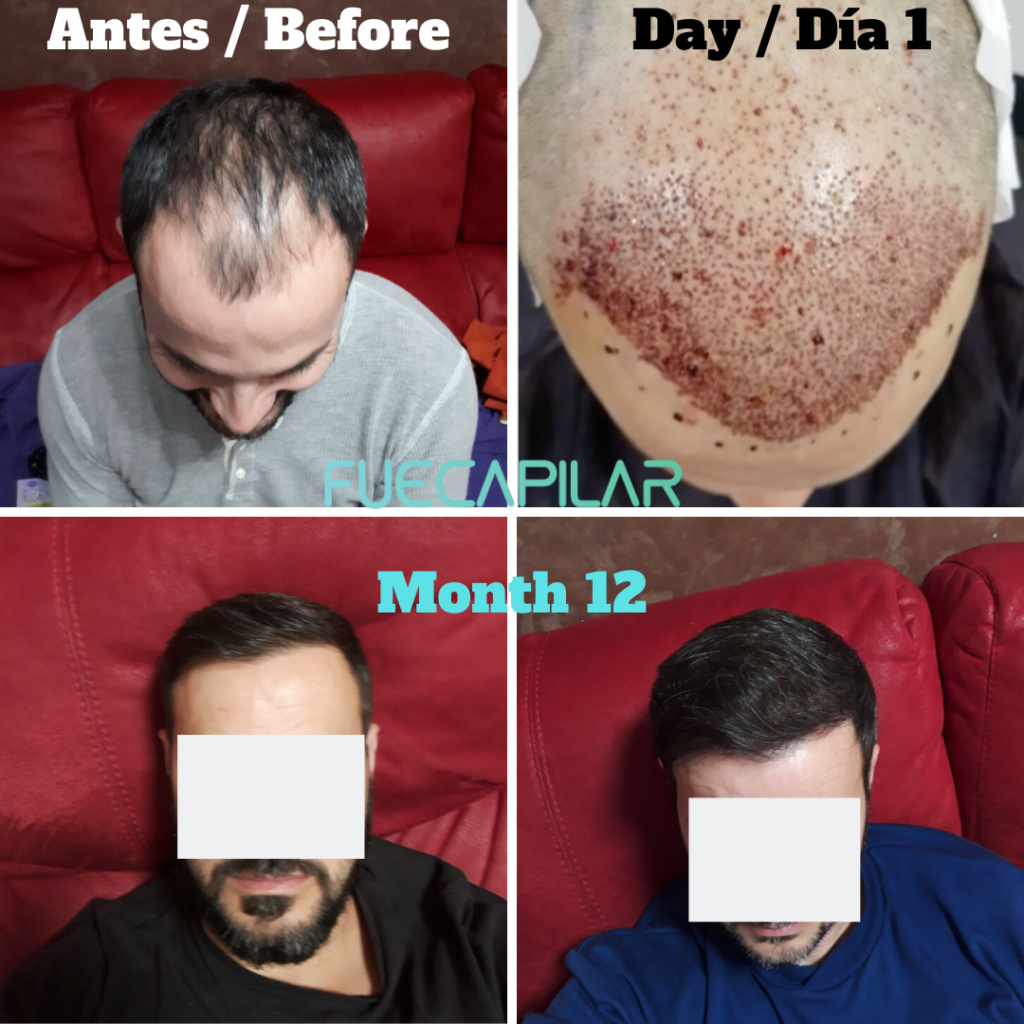 Fue capilar reviews: Before and After Picture