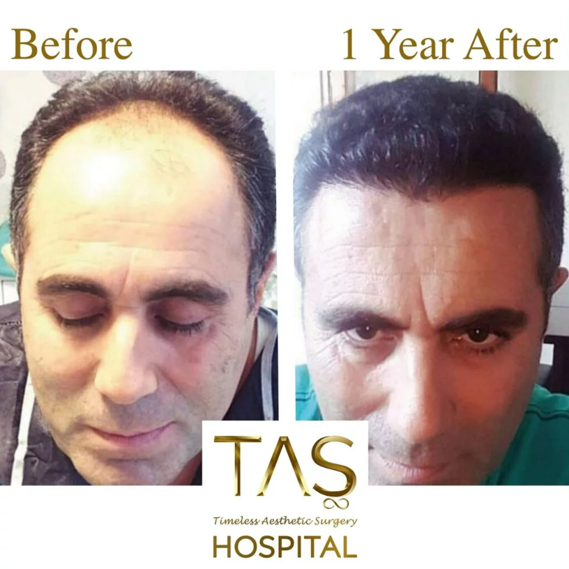 hair-transplant-before-and-after-turkey-1-TAS Clinic