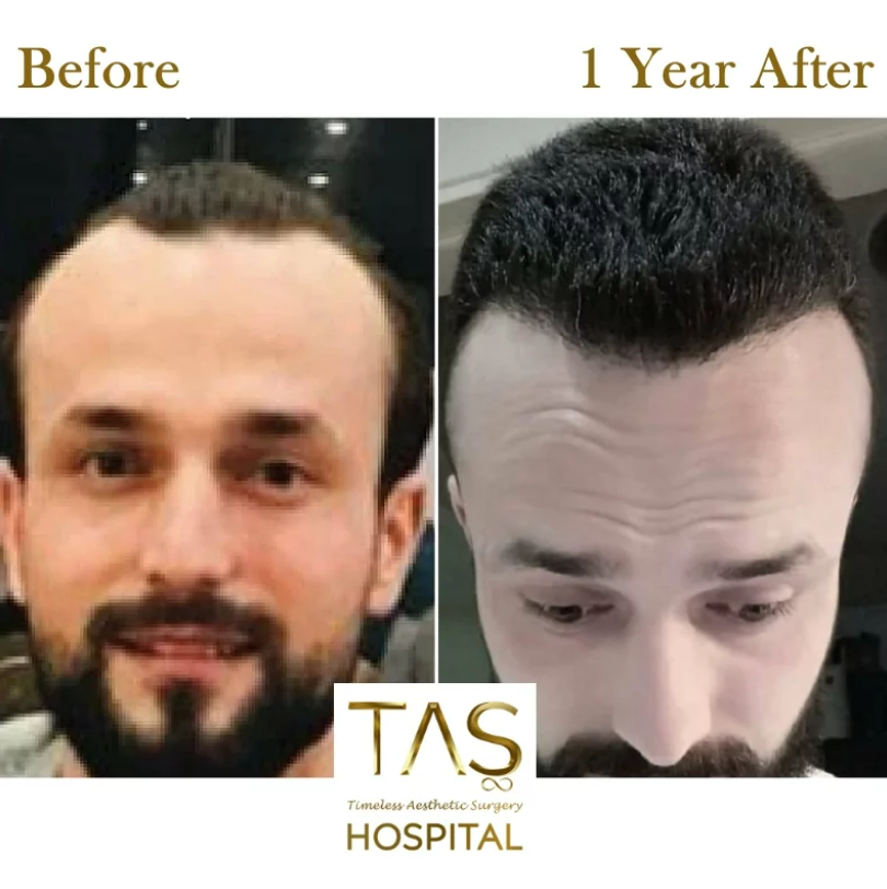 hair-transplant-before-and-after-turkey-1-TAS Clinic