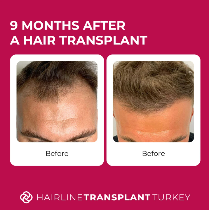 9 months after hair transplant - here is what to expect at the 9 month mark after your hair transplant 8 months after hair transplant - here is what to expect at the 8 month mark after your hair transplant impressive before and after pictures