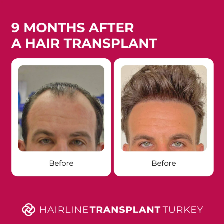 9 months after hair transplant - here is what to expect at the 9 month mark after your hair transplant 8 months after hair transplant - here is what to expect at the 8 month mark after your hair transplant impressive before and after pictures