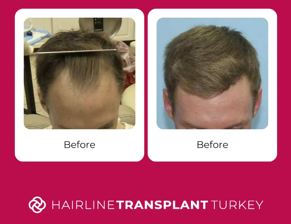 9 months after hair transplant - here is what to expect at the 9 month mark after your hair transplant 8 months after hair transplant - here is what to expect at the 8 month mark after your hair transplant impressive before and after pictures