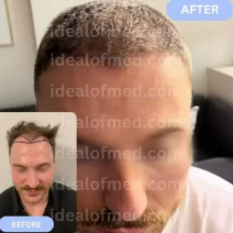 IdealofMeD Before & After Female Hair transplant