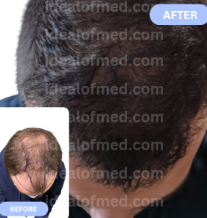 IdealofMeD Turkey Before and After Hair Transplant