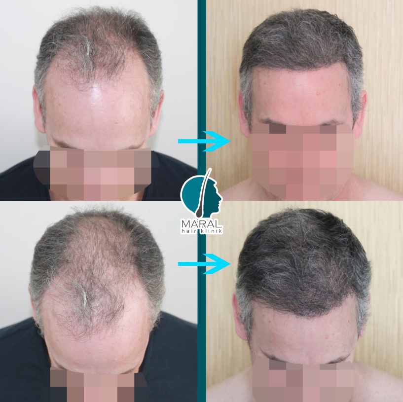 maral hair clinic review 2