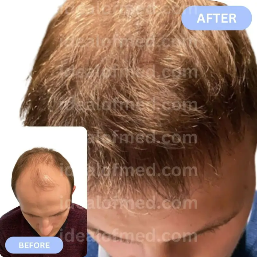 Hairtransplant Turkey Reviews, Before and After IdealofMeD