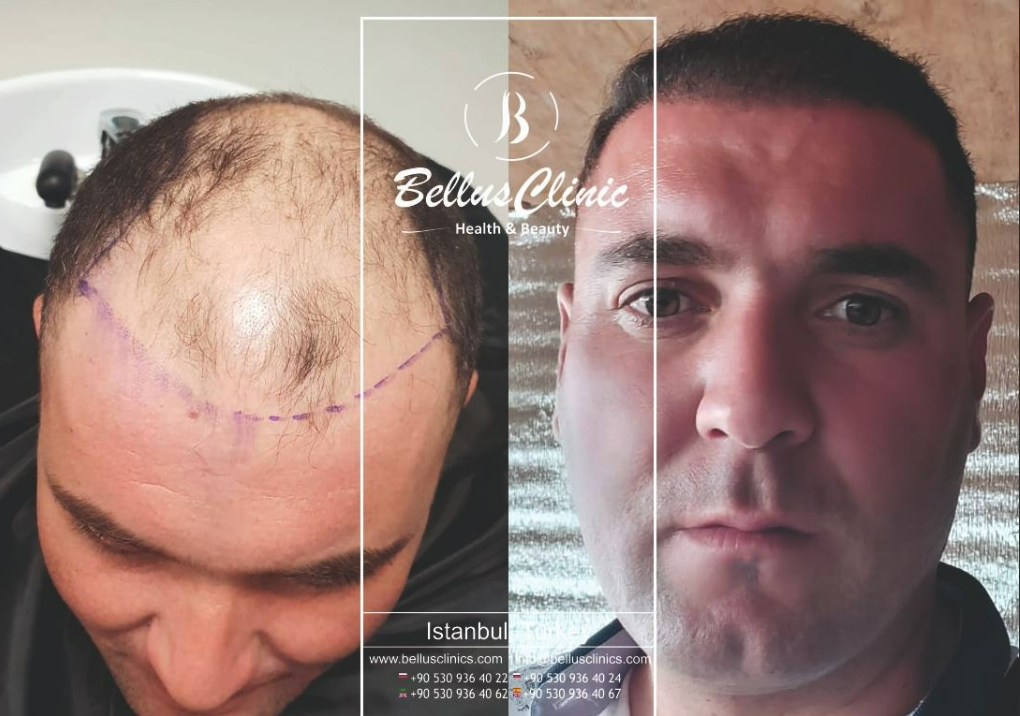 Bellus Clinic Istanbul before and after picture