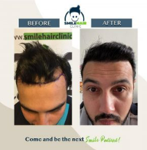 Smile hair clinic review Before and after hair transplant images