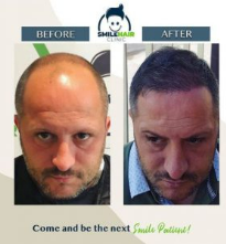 Smile hair clinic review Before and after hair transplant images