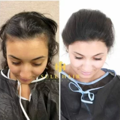 Sule Clinic Woman hair transplant
