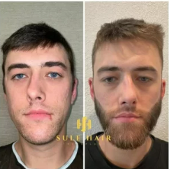 Sule Hair Turkey Before and After