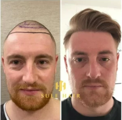 Sule Clinic hair transplant before and after